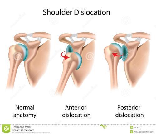 看我的肩膀，都脱臼了呀,揭秘肩部损伤的严重后果
